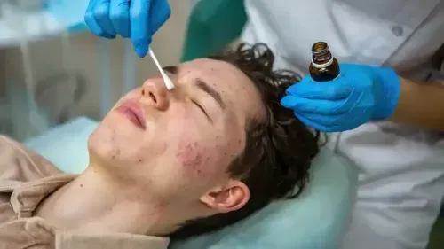 What is the Cost of Acne Scar Treatment in Hyderabad?